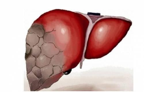 慢性乙肝并發癥-肝源性糖尿病